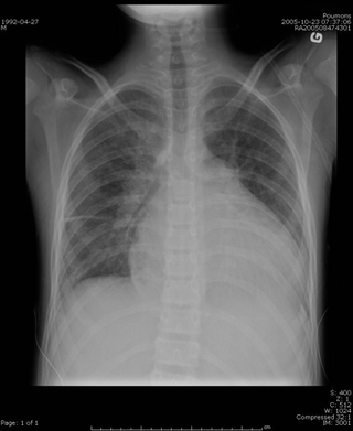 cardiomegalie Urgence CHU SainteJustineUrgence CHU SainteJustine