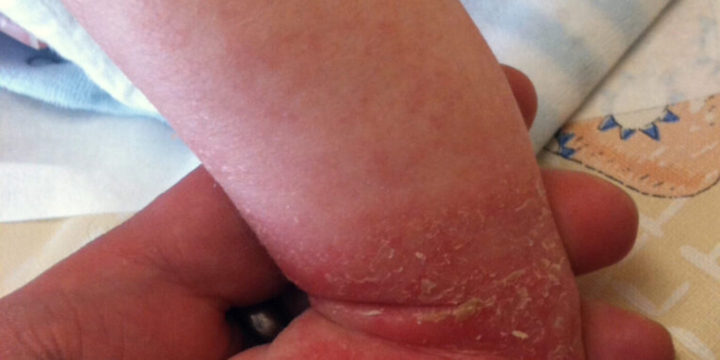 Atopic_dermatitis_child_2