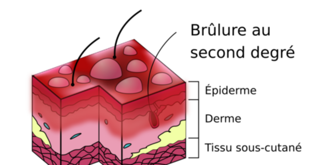 Burn_Degree_Diagram-fr Wikimedia Commons