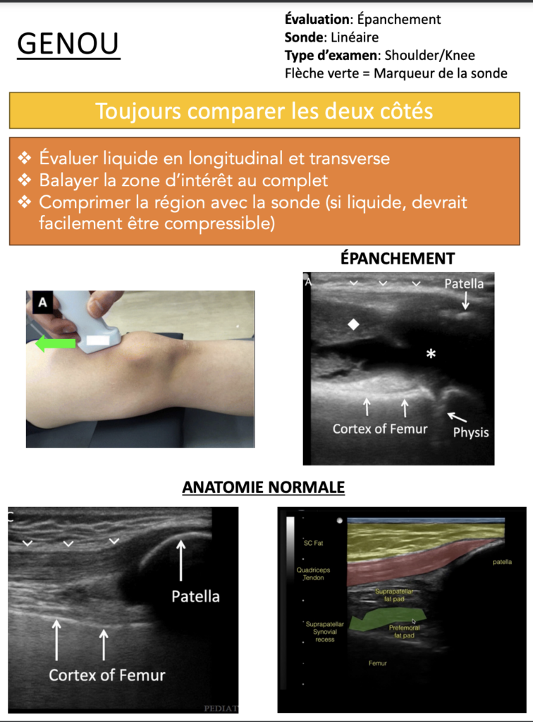 Ponction Genou Aide M moire Urgence CHU Sainte Justine