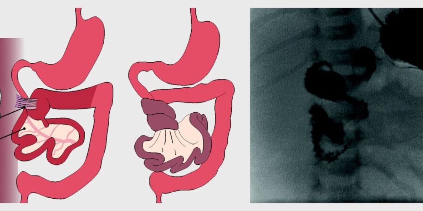 Classic intestinal malrotation the BMJ