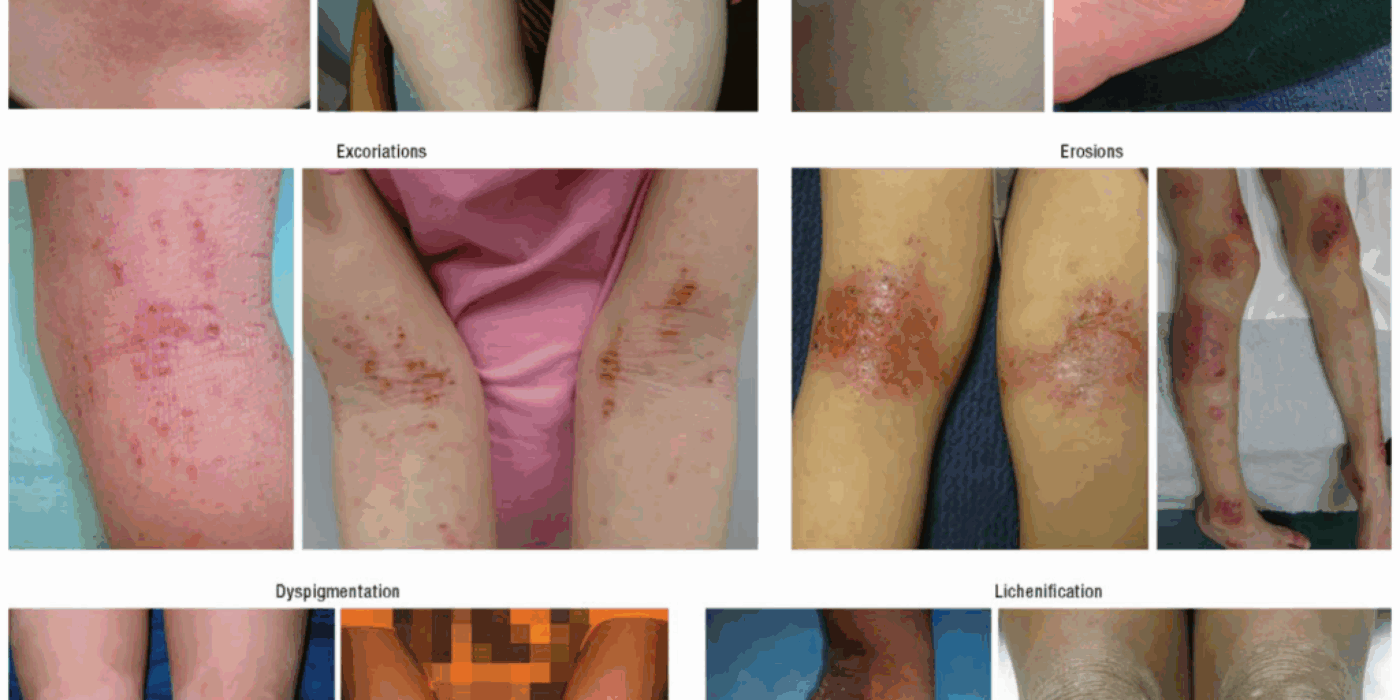 Clinical_features_of_atopic_dermatitis_in_English Wikimedia commons