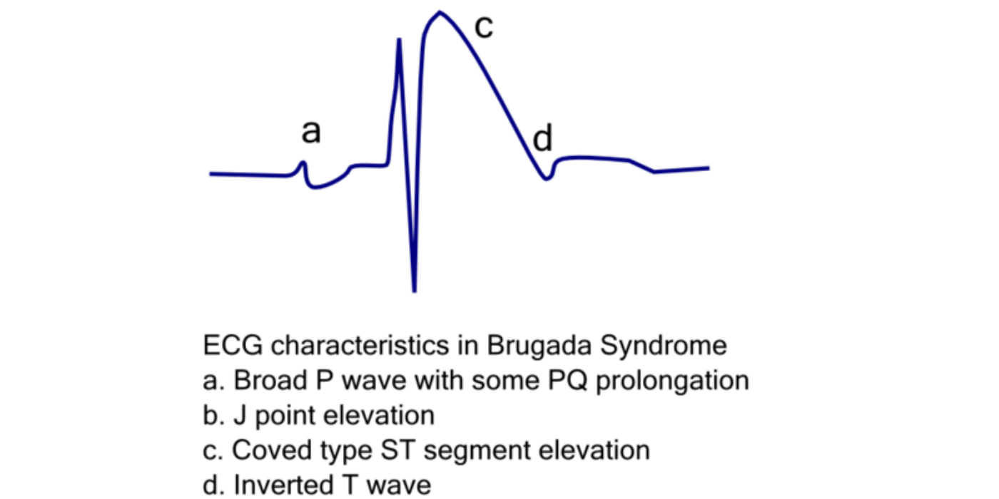De-Brugada_ecg_characteristics_(CardioNetworks_ECGpedia)