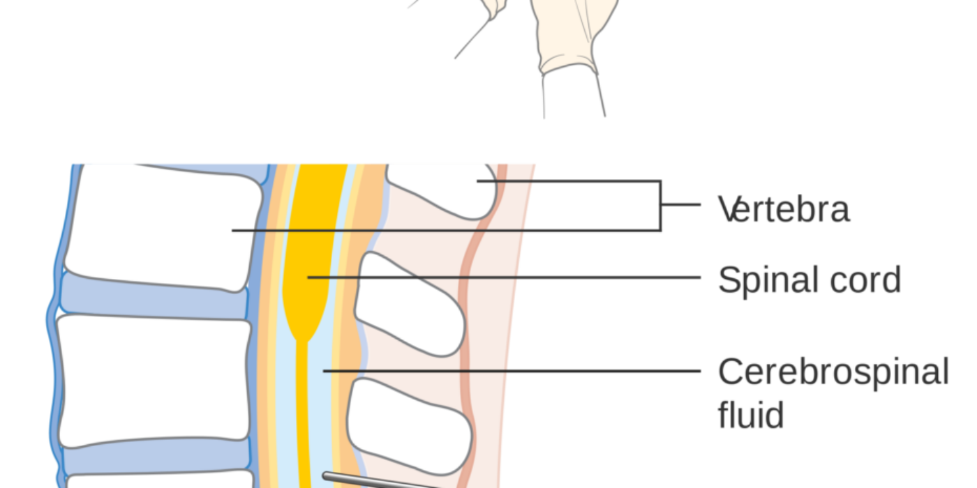 Diagram_showing_how_you_have_a_lumbar_puncture_CRUK_157.svg