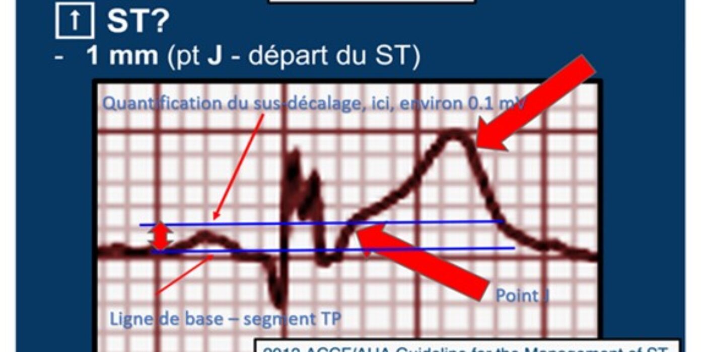 ECG