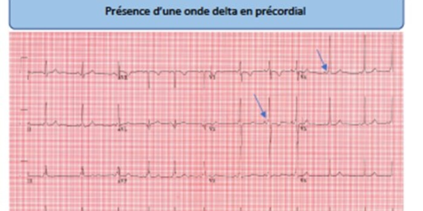 ECG ANORMAL 13 ans WPW
