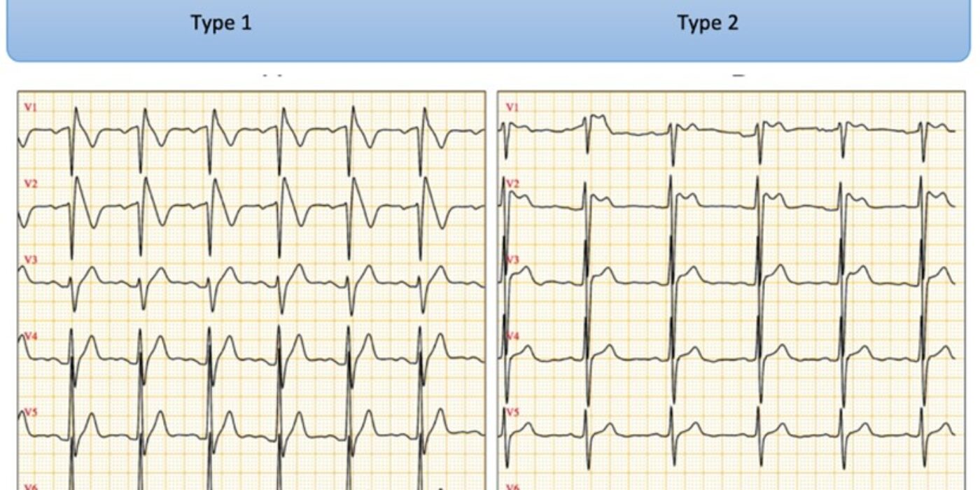 ECG ANORMAL Brugada