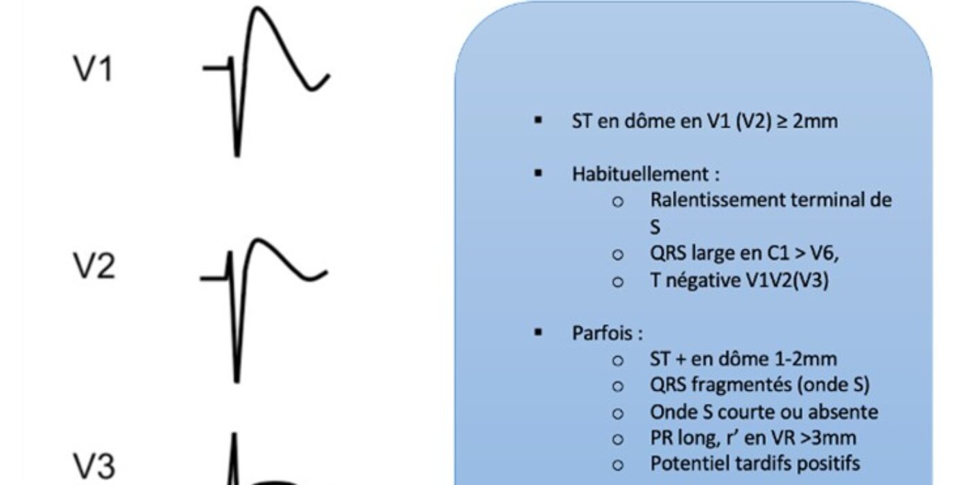 ECG ANORMAL Brugada description