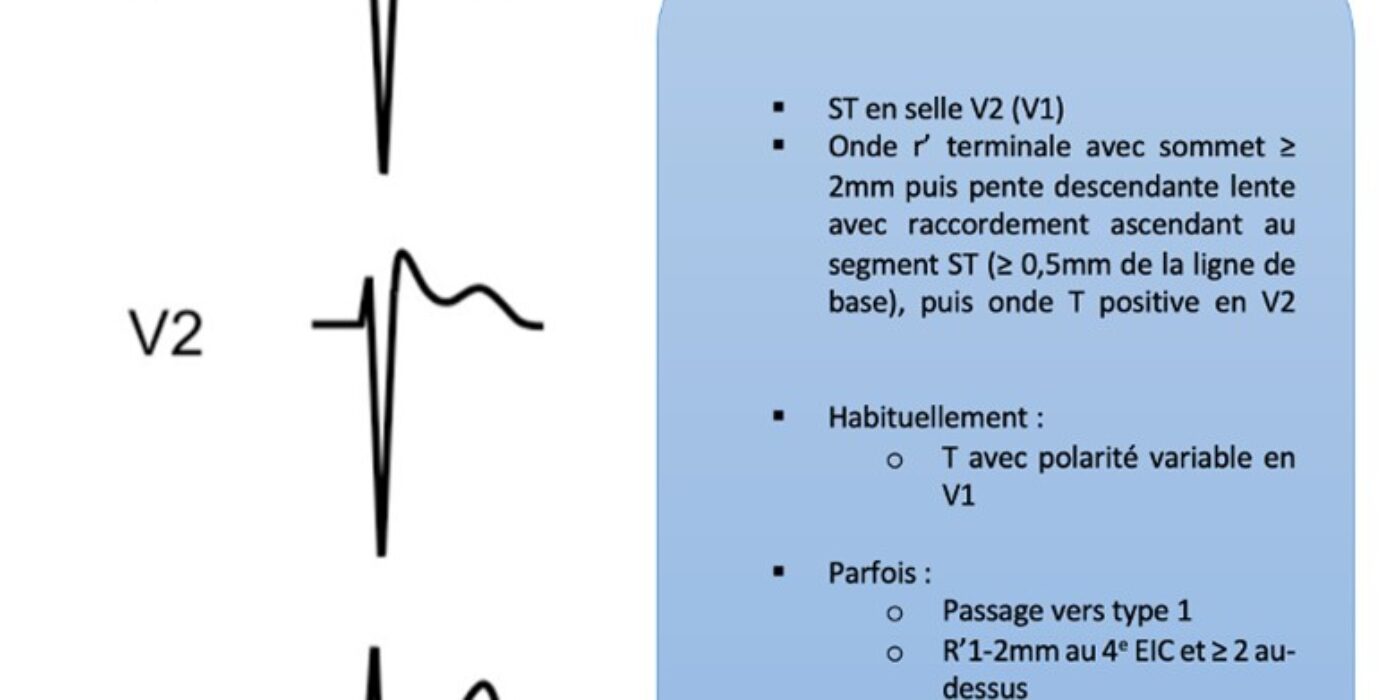 ECG ANORMAL Brugada description 2