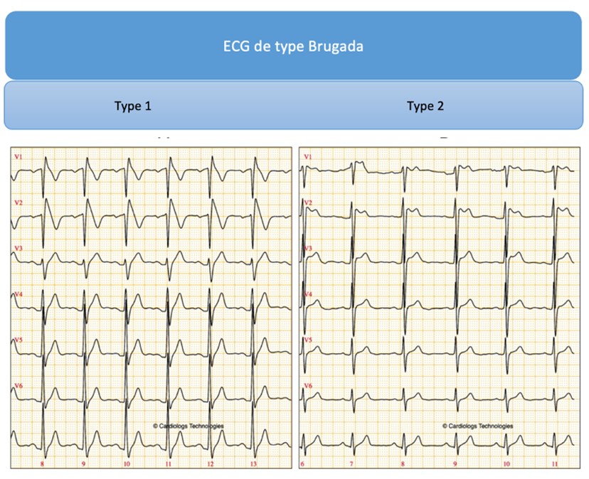 ECG P diatrique Urgence CHU Sainte Justine ECG P diatrique Urgence CHU Sainte Justine