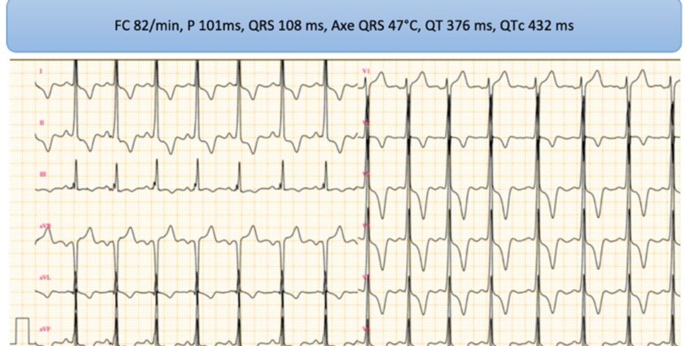 ECG ANORMAL cardiomyopathie hypertrophique