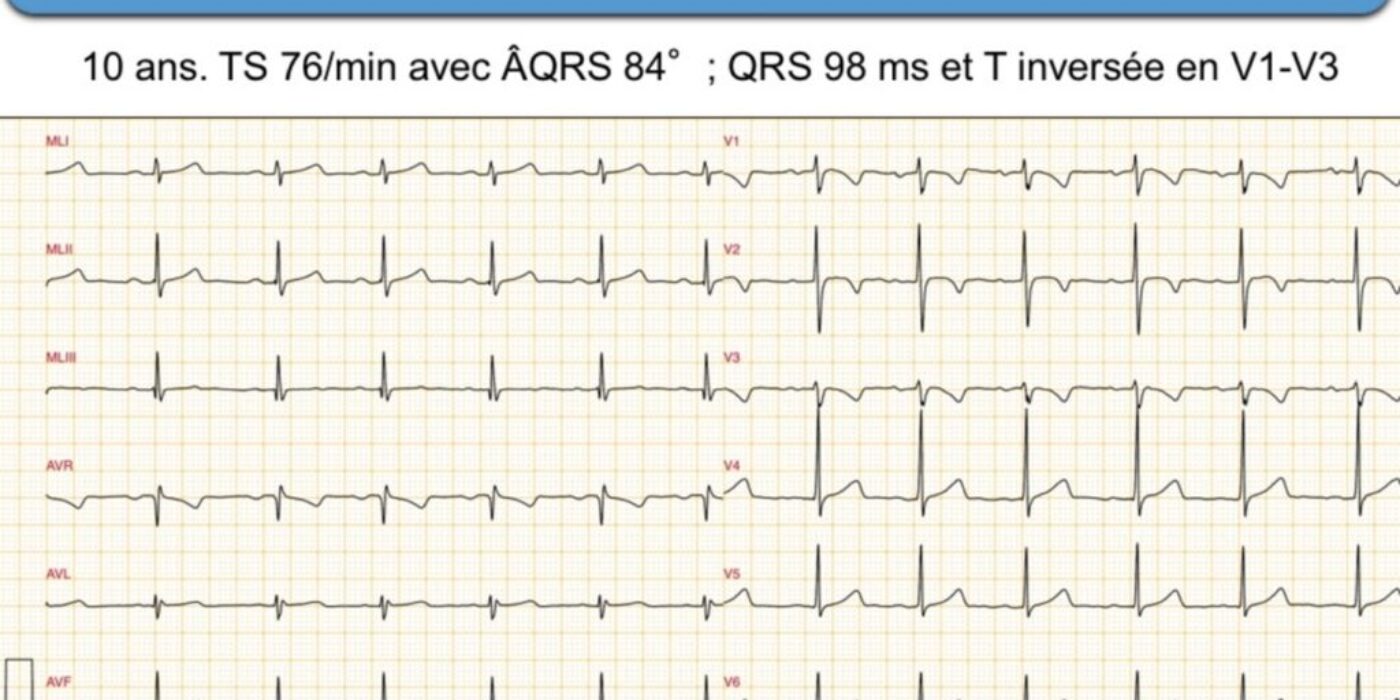 ECG normal patient de 10 an Tiré du guide syncope