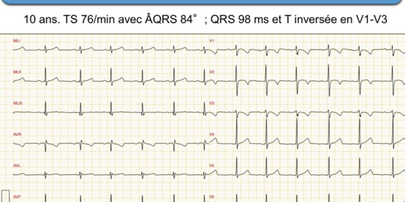 ECG normal patient de 10 an Tiré du guide syncope