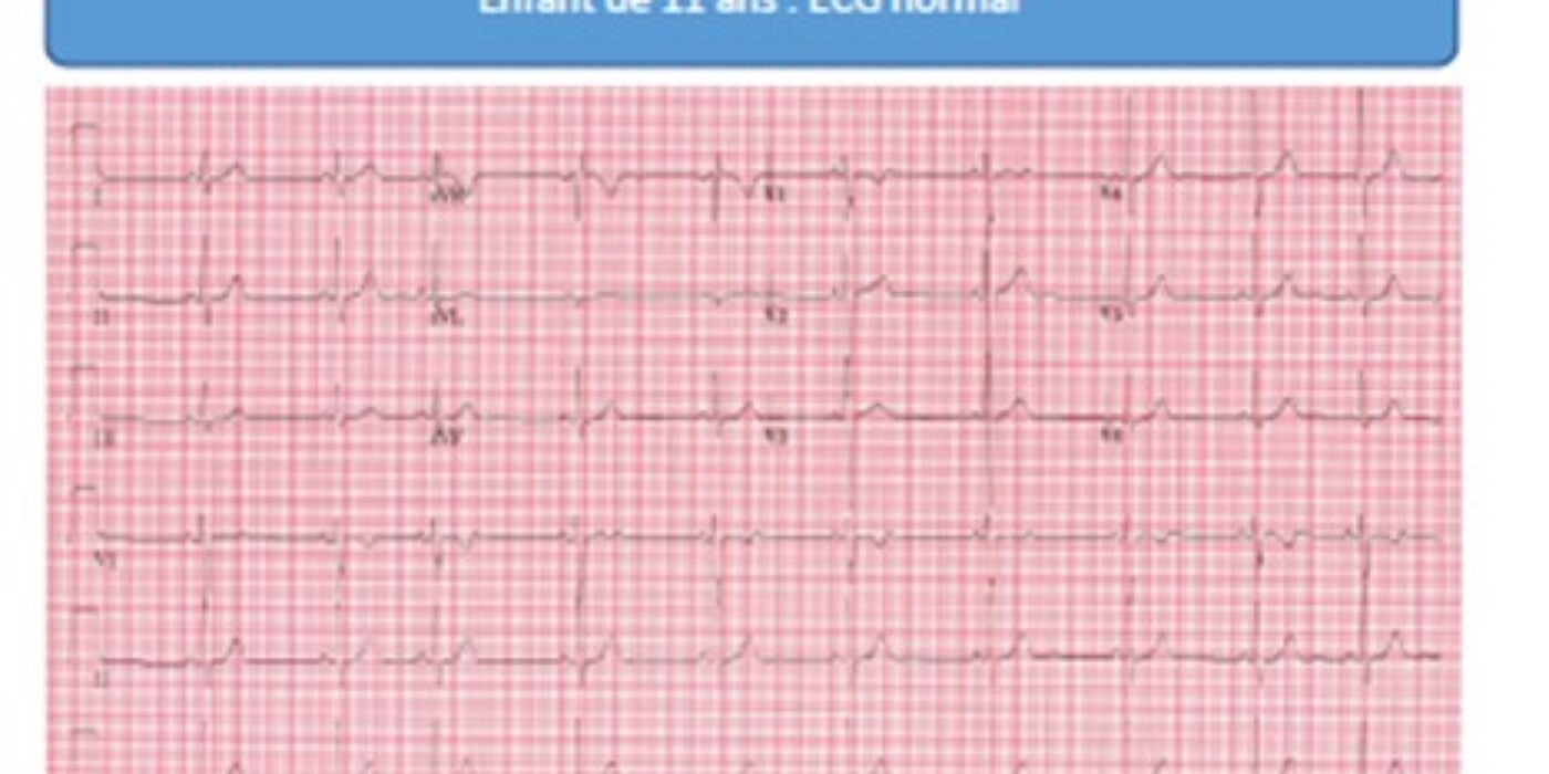 ECG normal patient de 11 ans Tiré du guide syncope