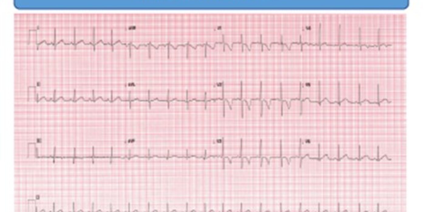 ECG normal patient de 14 mois Tiré du guide syncope