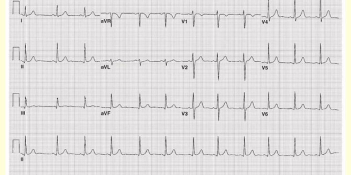 ECG normal patient de 15 ans Tiré de L'ECG pédiatrique par A Fournier urgencehsj.ca