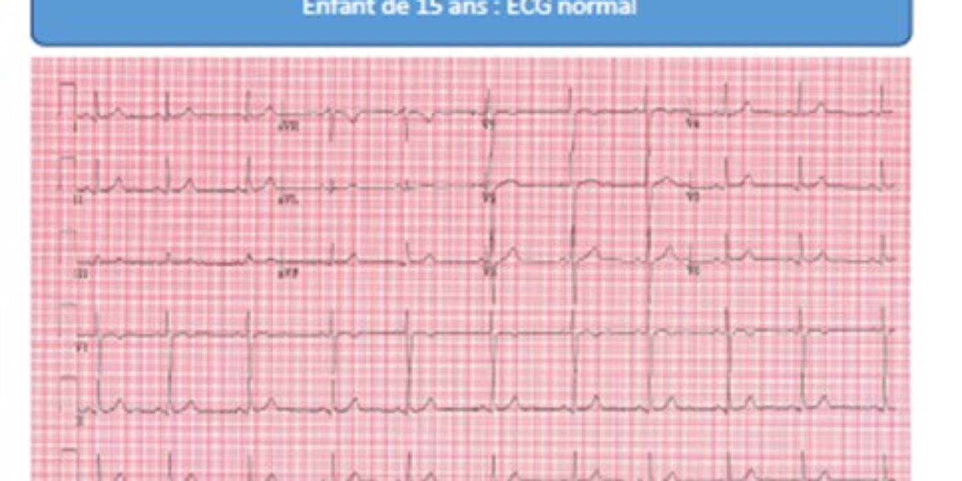 ECG normal patient de 15 ans Tiré du guide syncope