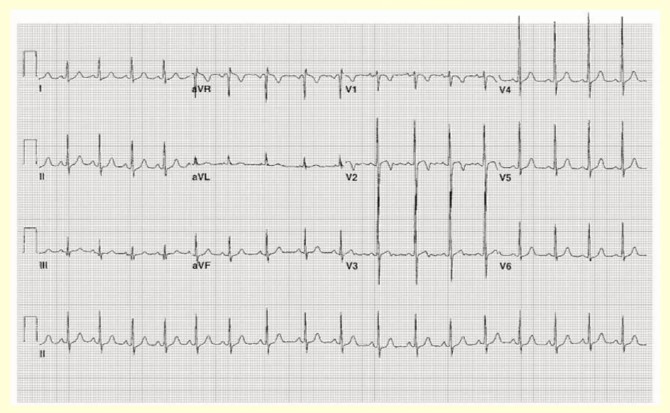 ECG P diatrique Urgence CHU Sainte Justine ECG P diatrique Urgence CHU Sainte Justine