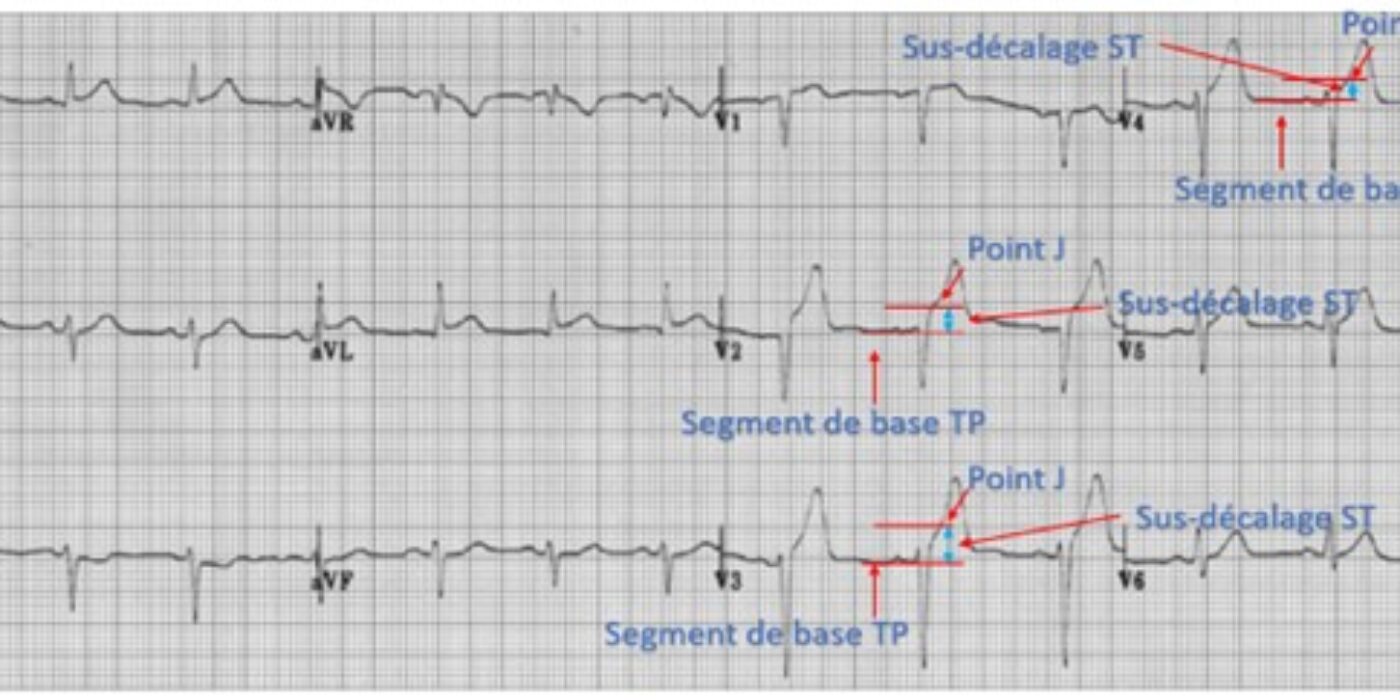 ECG2