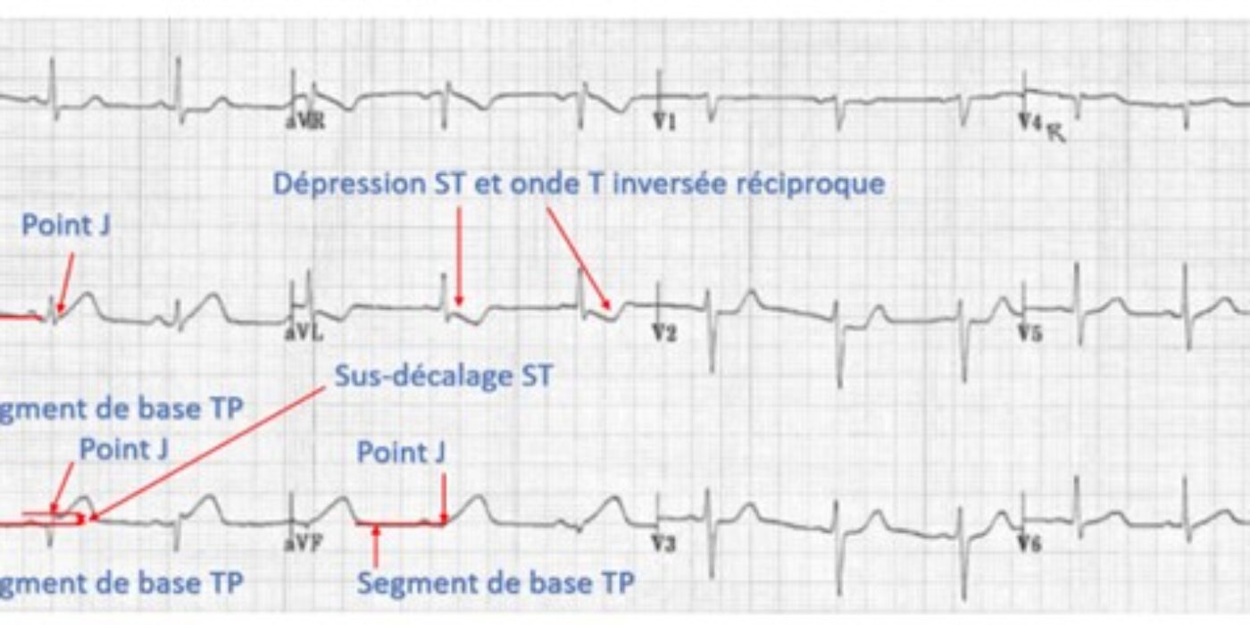 ECG3