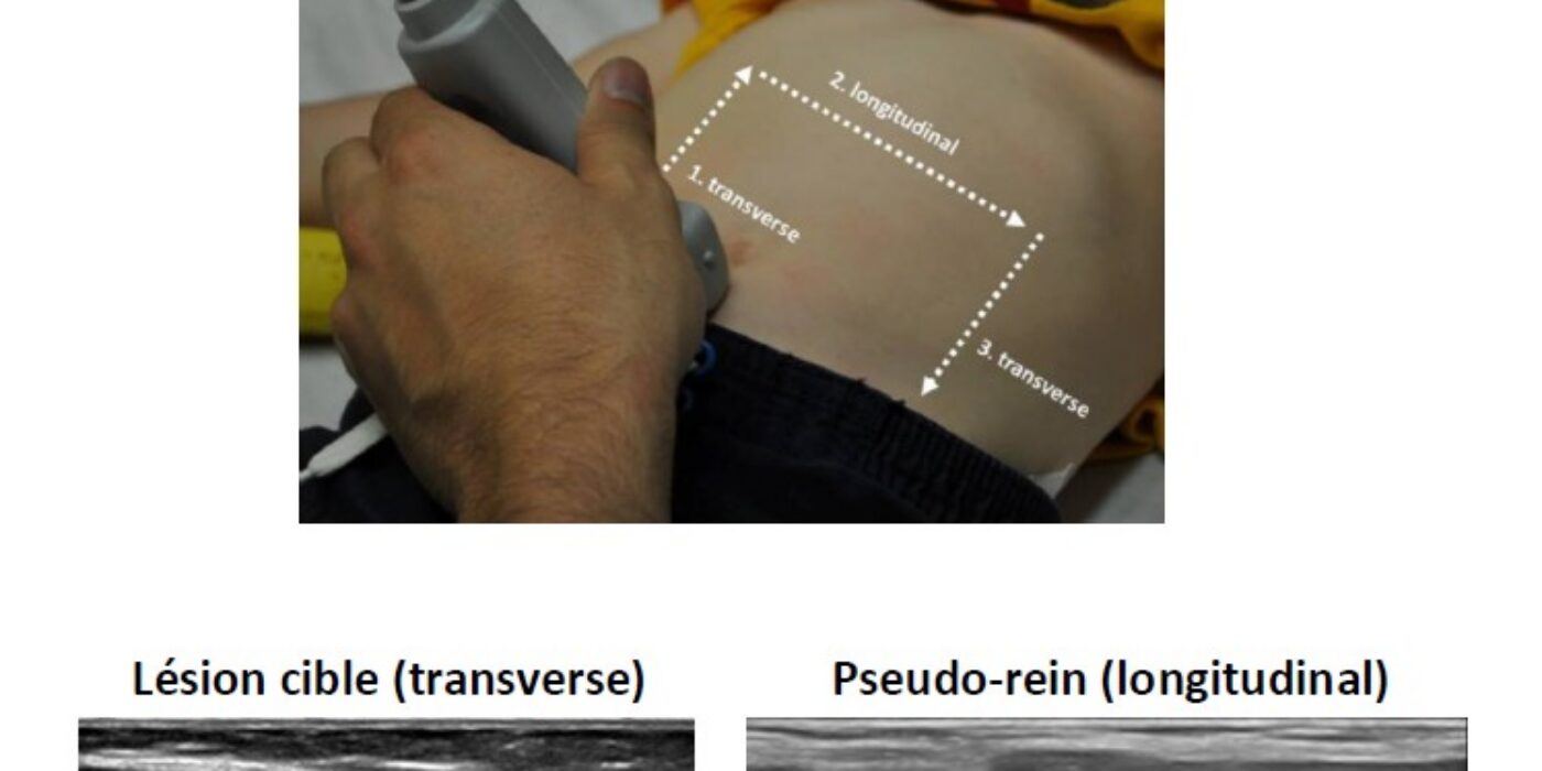 EDU 3 invagination