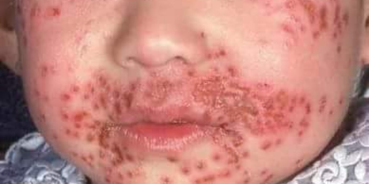 Eczema_herpitcum