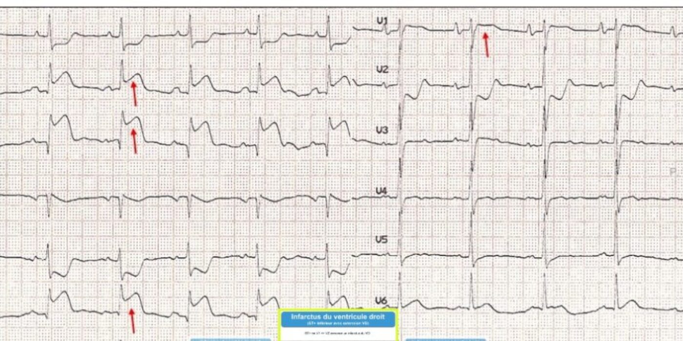 Infarctus droit