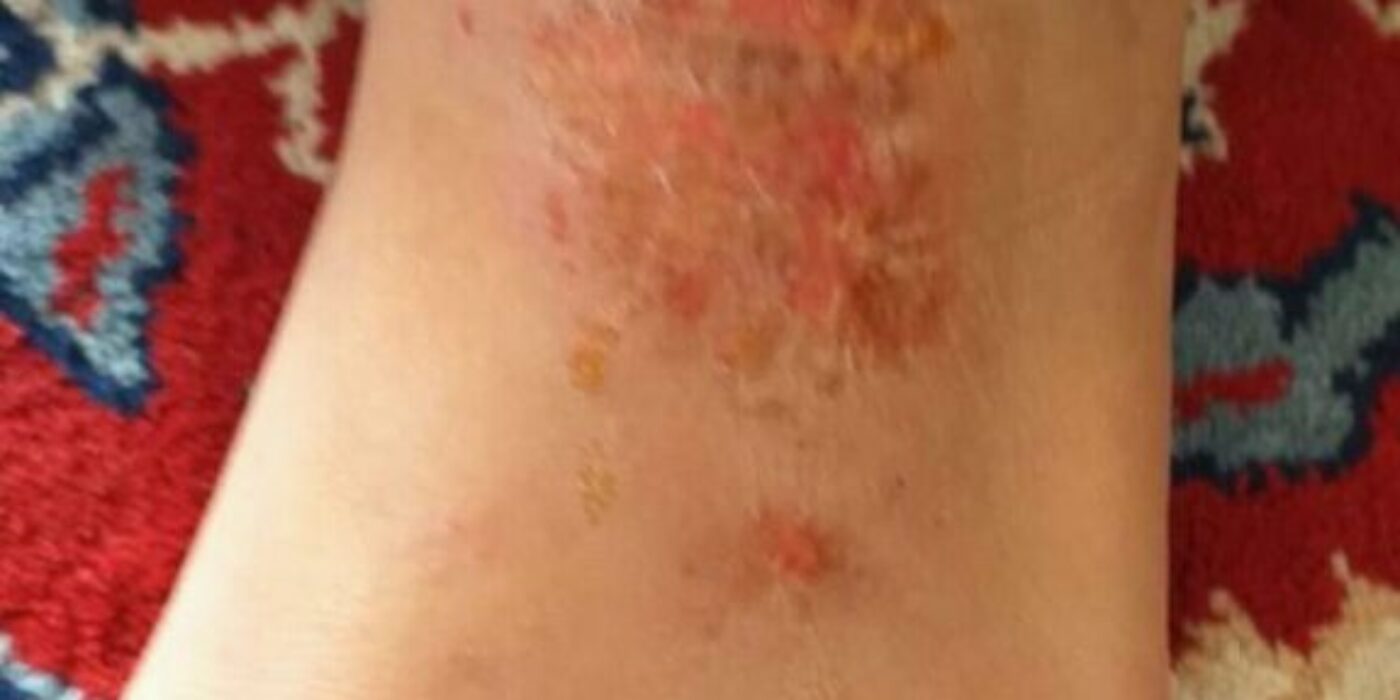 Lichen_simplex_chronicus