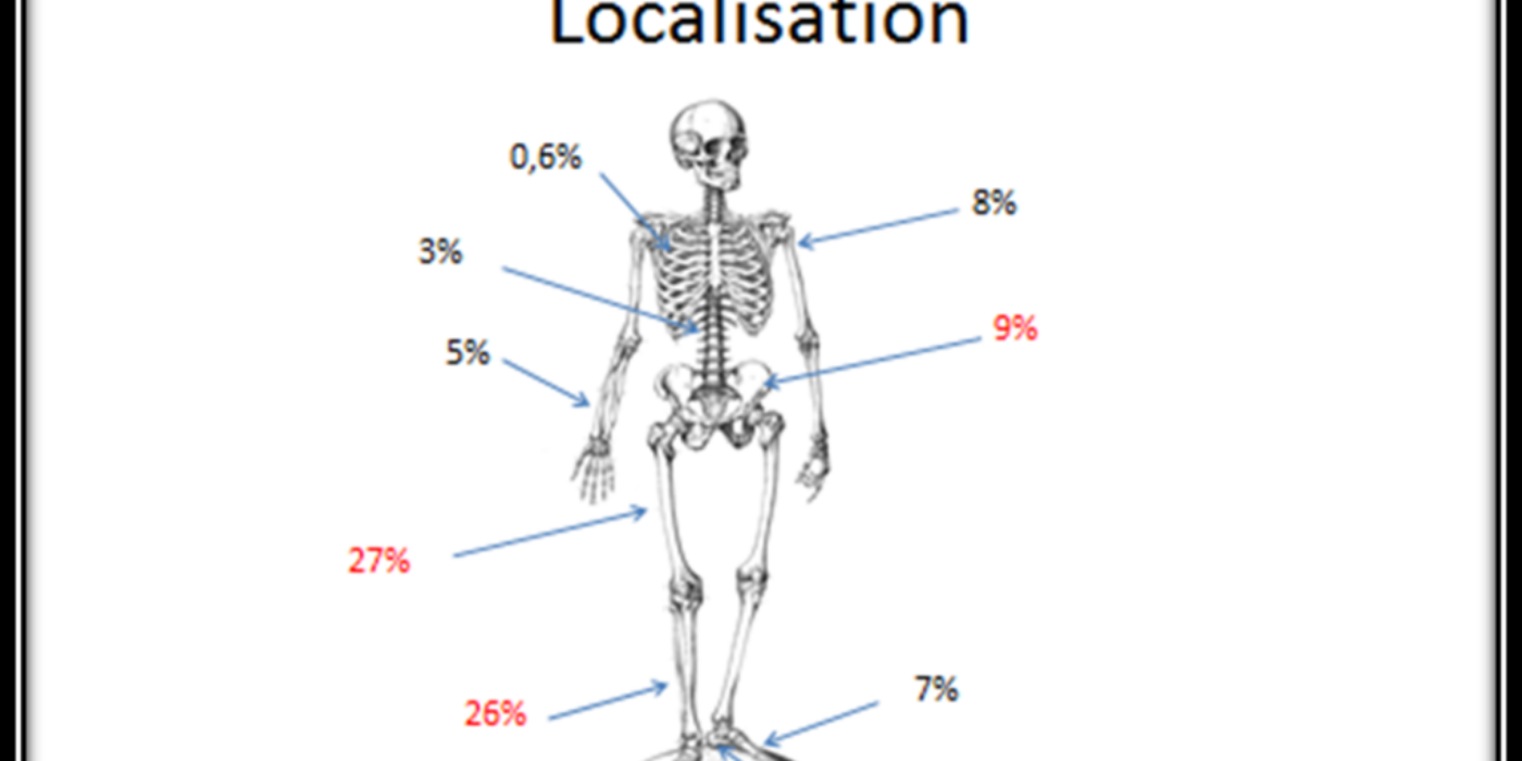 Localisation ostéomyelite