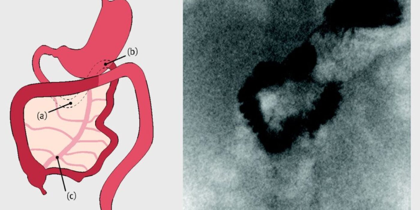 Normal intestine rotation The BMJ