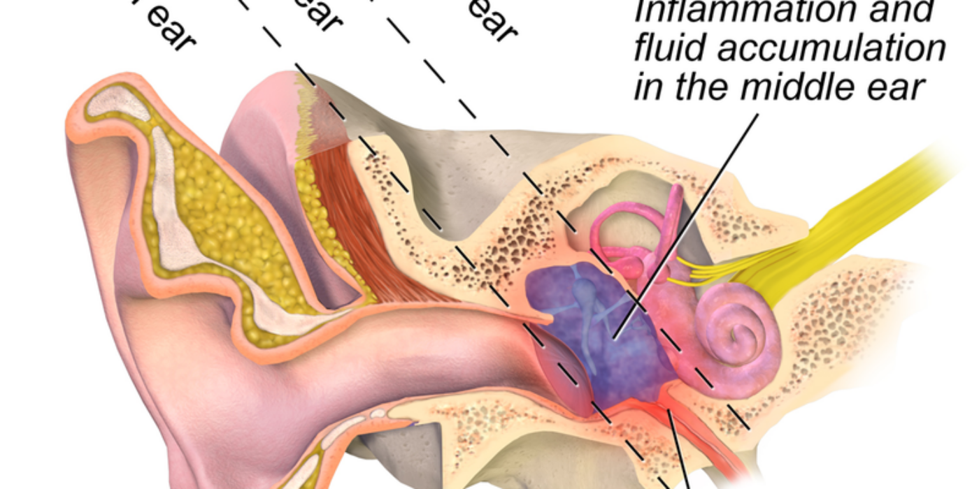 Otitis_Media