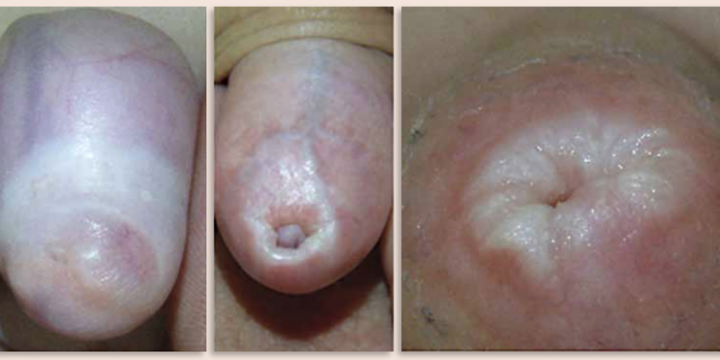 Phimosis pathologique