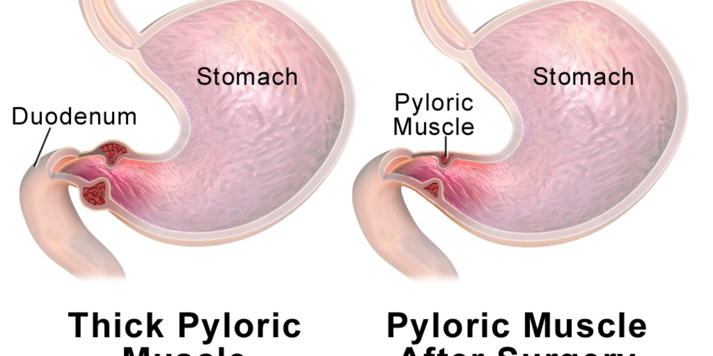 Pyloric_Stenosis