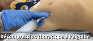 Phimosis - Urgence CHU Sainte-Justine