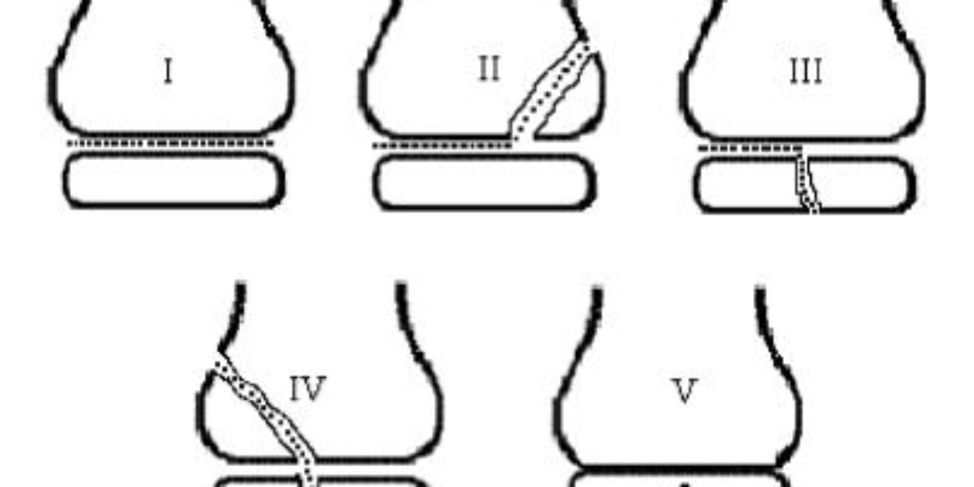 The Salter-Harris Classification Of Pediatric Fractures Pediatric Emergency Medicine Practice