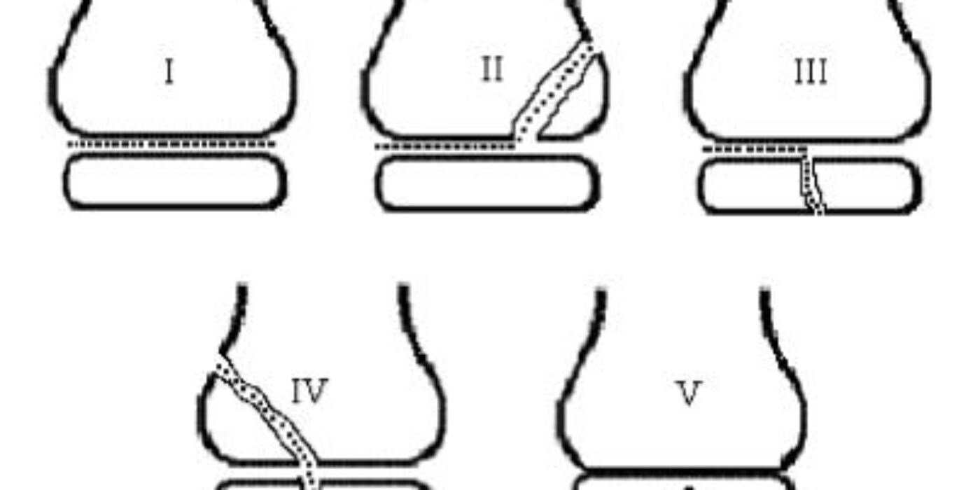 The Salter-Harris Classification Of Pediatric Fractures Pediatric Emergency Medicine Practice