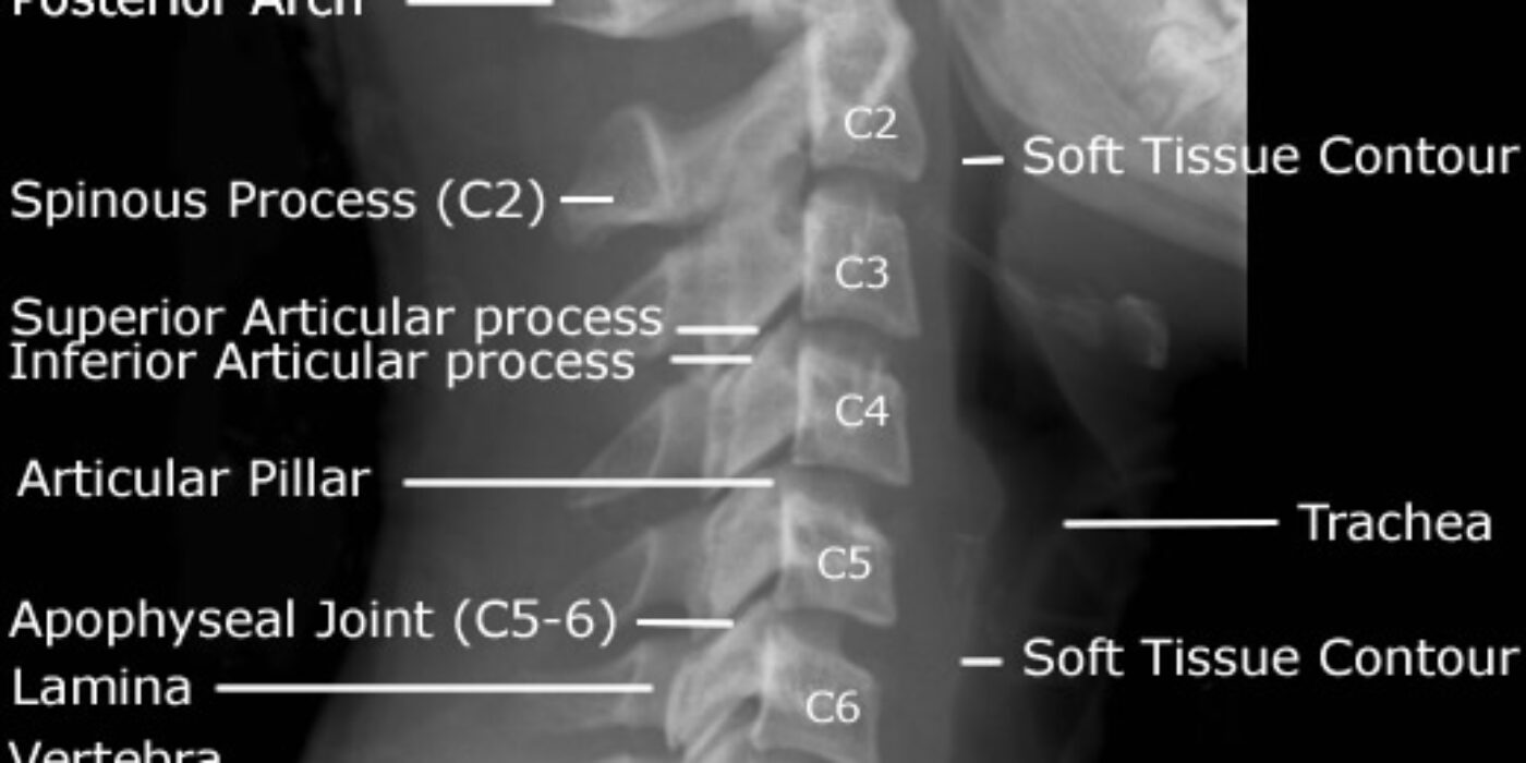 cervical-spine-lateral