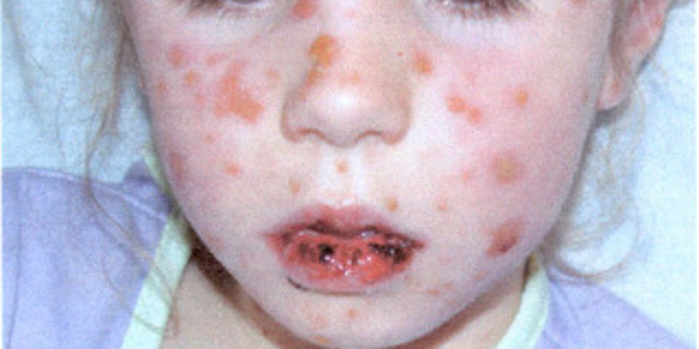 fille4ansrash Urgence CHU SainteJustine