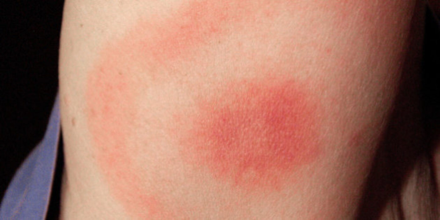 http—i.huffpost.com-gen-4508812-images-n-LYME-DISEASE-628×314