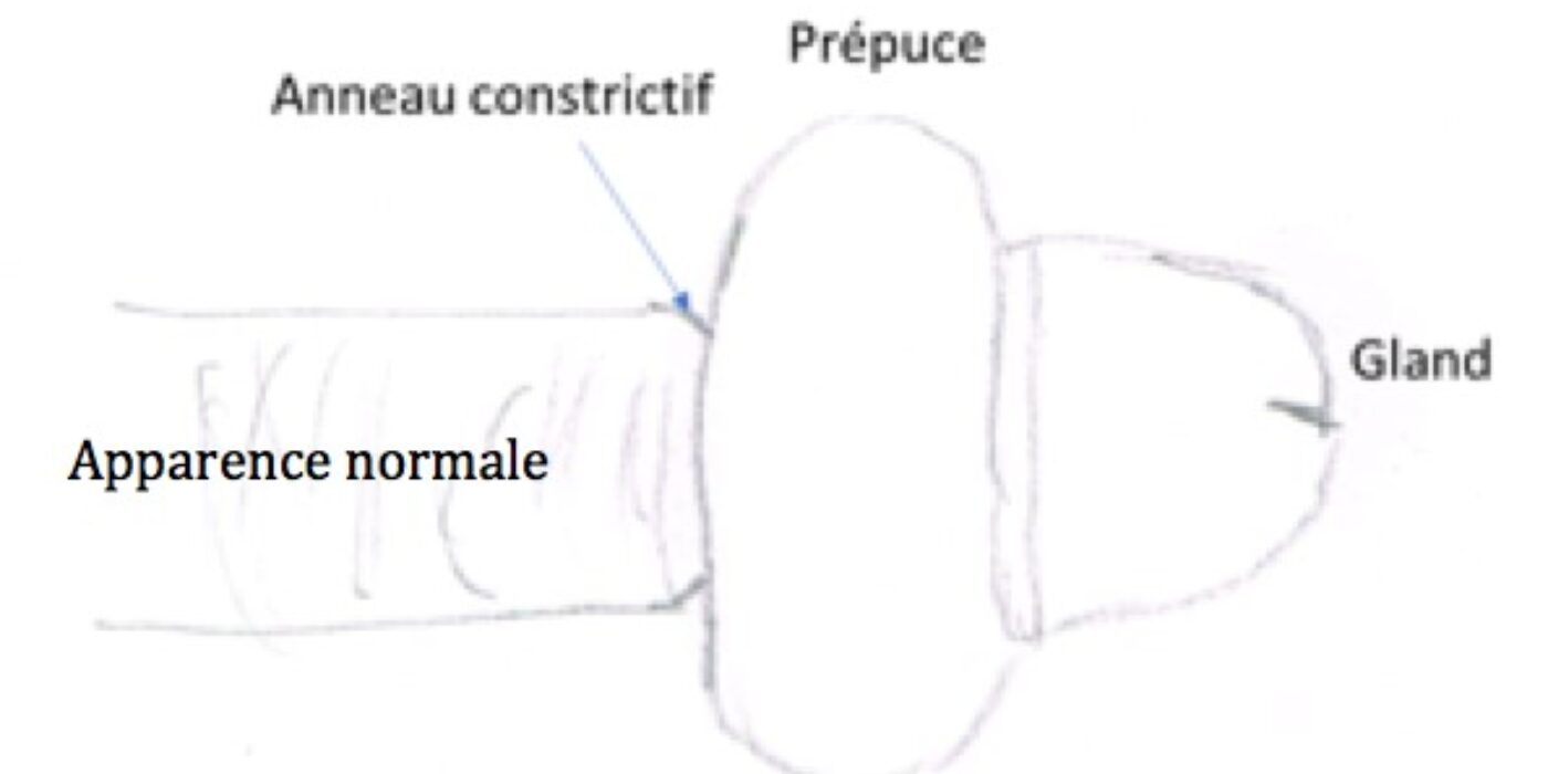 paraphimosis