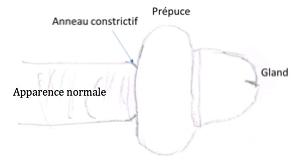 Paraphimosis - Urgence CHU Sainte-Justine