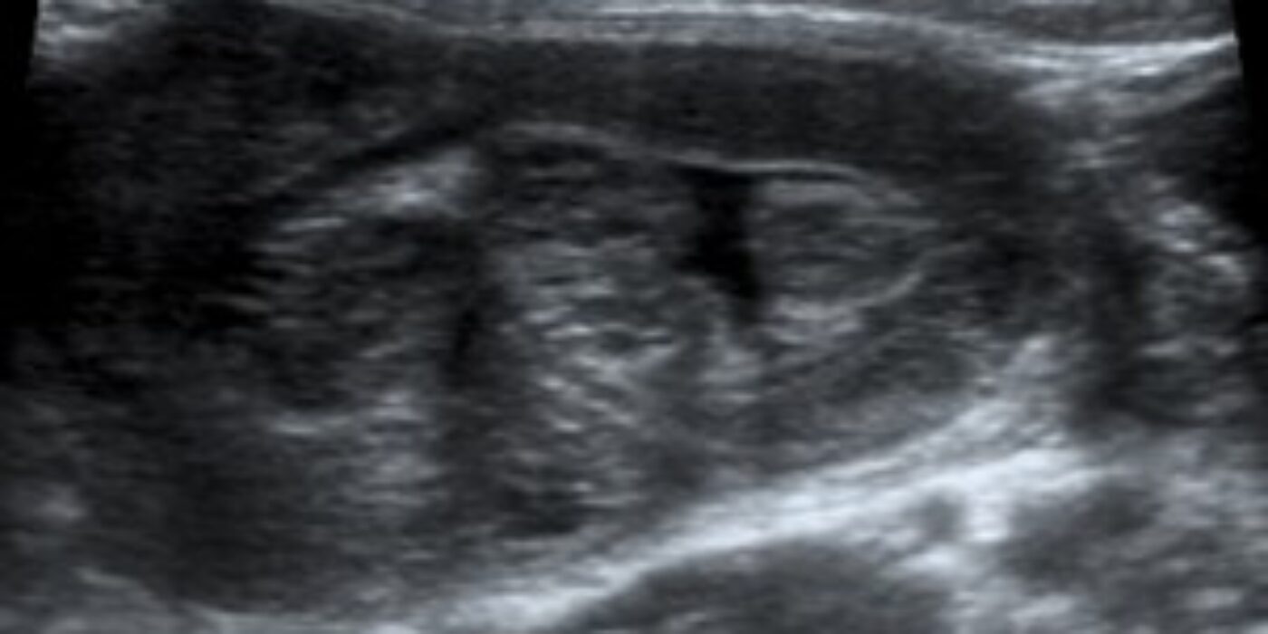 vue kidney